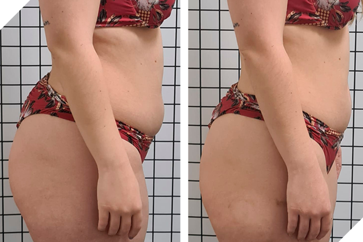 Lipocavitação Avançada